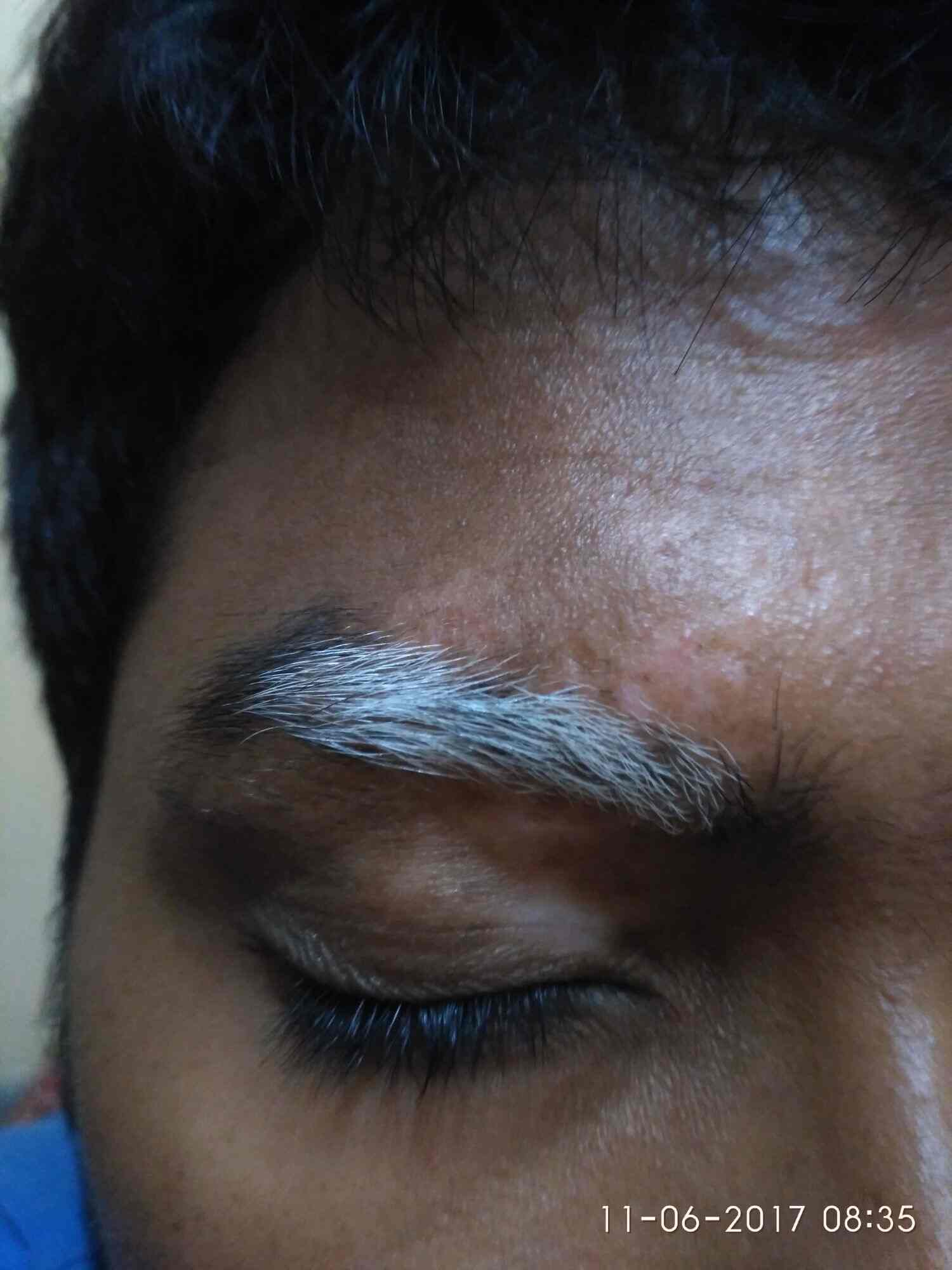 Noble Vitiligo Clinic Reviews Bangalore 13 Ratings Justdial Page 2